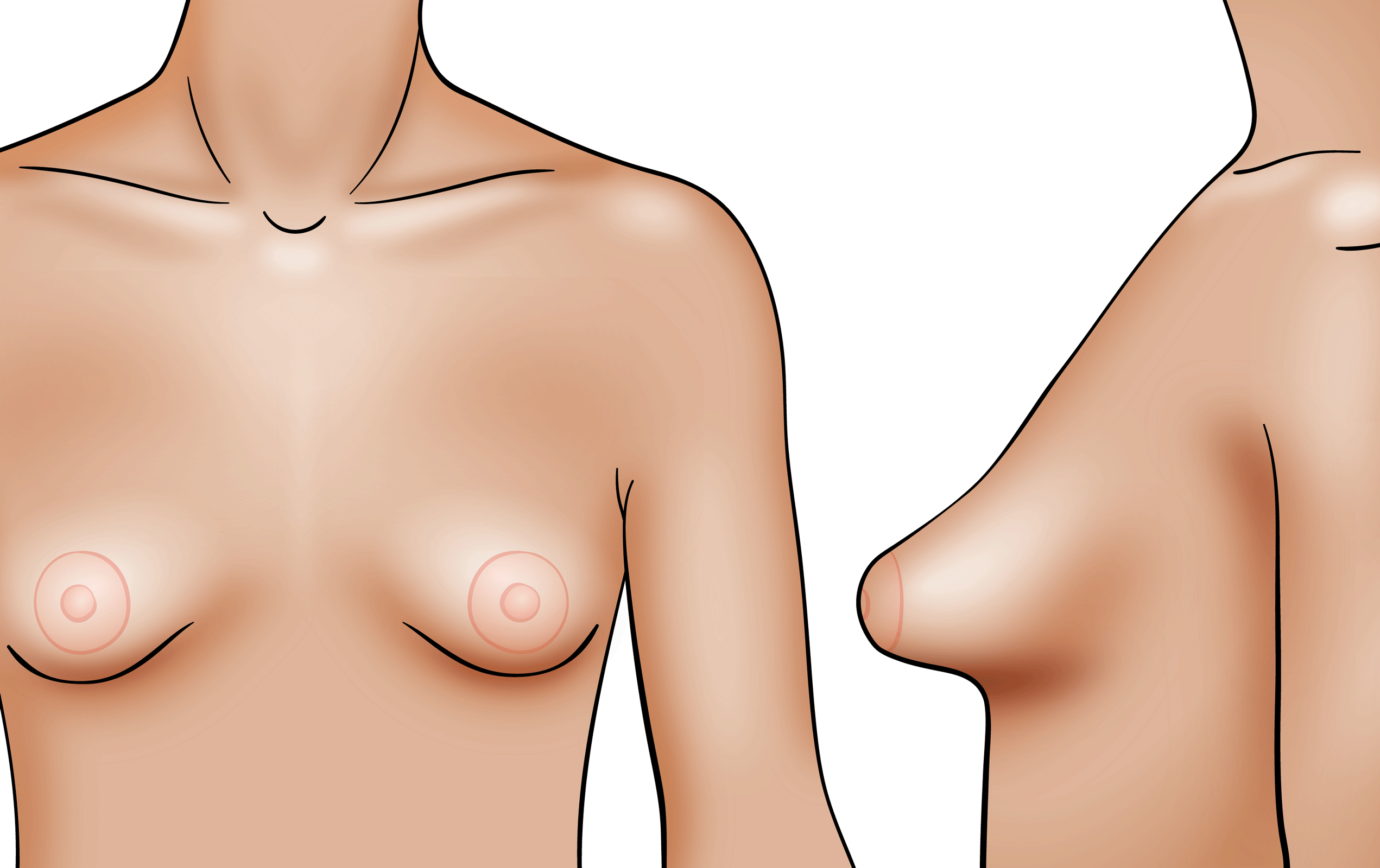 Saggy tube tits