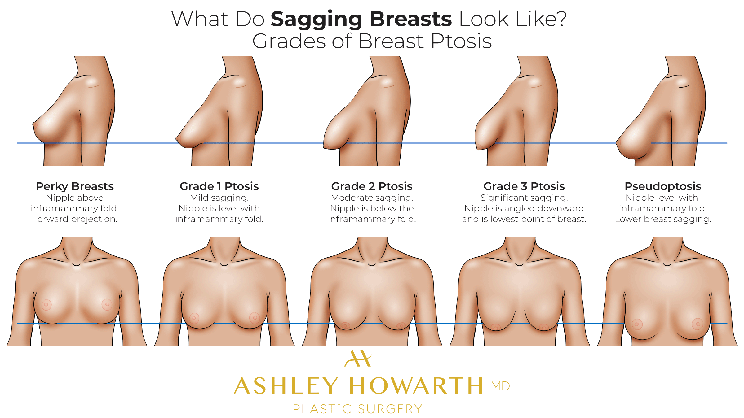 Sagging Breasts Classification - Saggy Breast Ptosis Classification