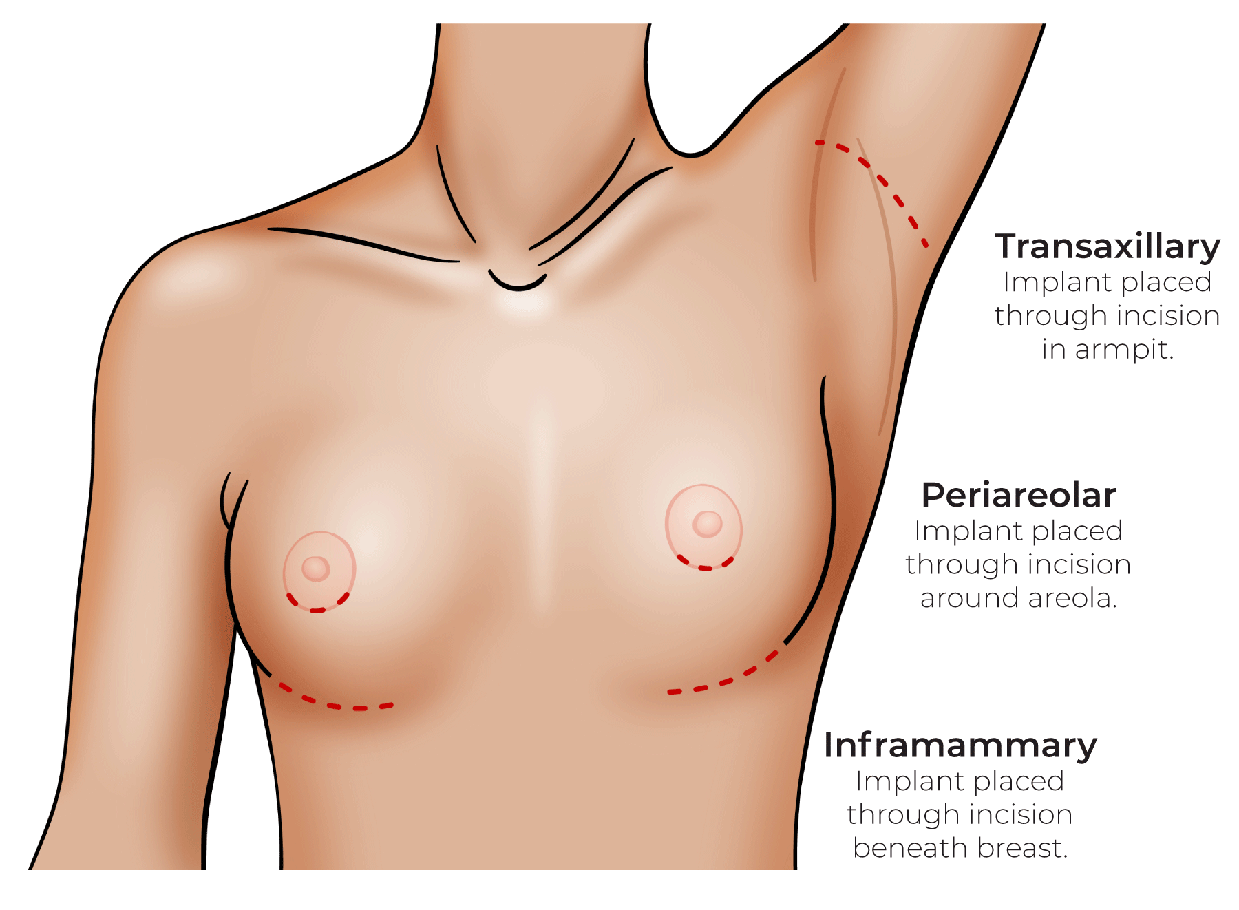 Breast Implant Scars