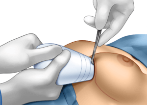 Keller Funnel Breast Augmentation