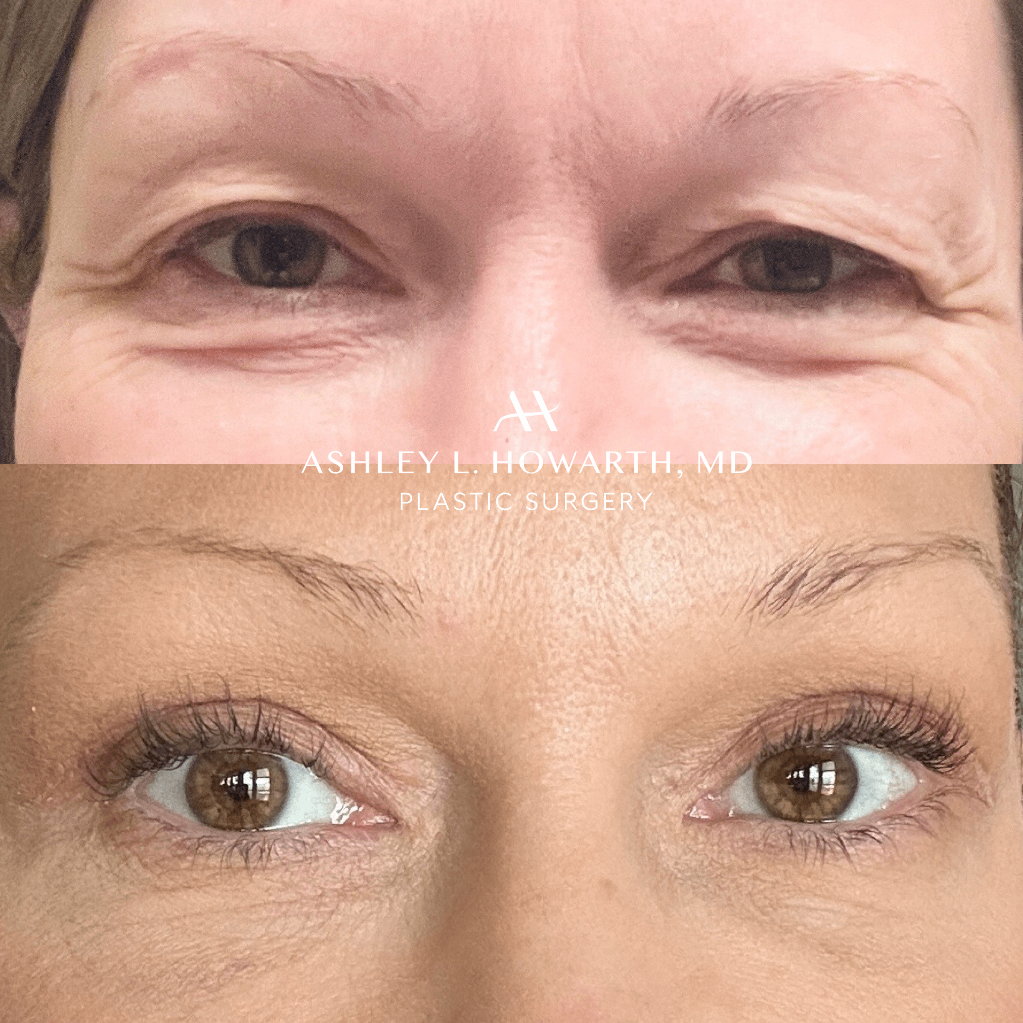 Upper lower blepharoplasty before after by Dr. Ashley Howarth. Upper lower eyelid surgery by board-certified plastic surgeon.