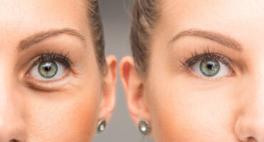 Eyelid Surgery Before After