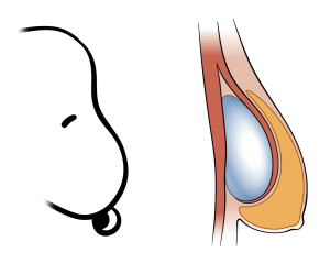 Snoopy breast deformity or waterfall deformity