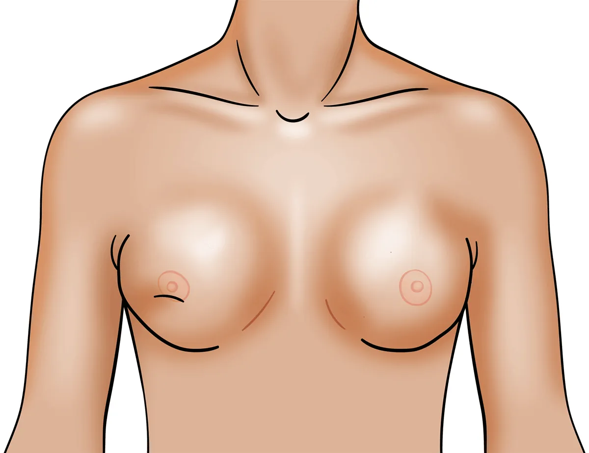 Capsular Contracture Baker Grade 4 IV