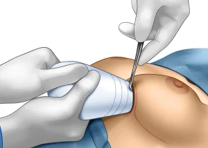 Keller Funnel Breast Augmentation