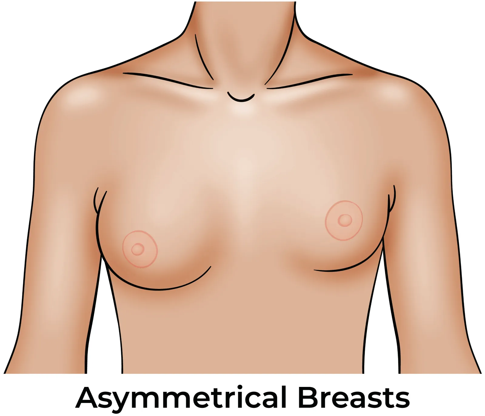 Asymmetrical breasts - Uneven breast revision Scottsdale AZ Plastic Surgeon