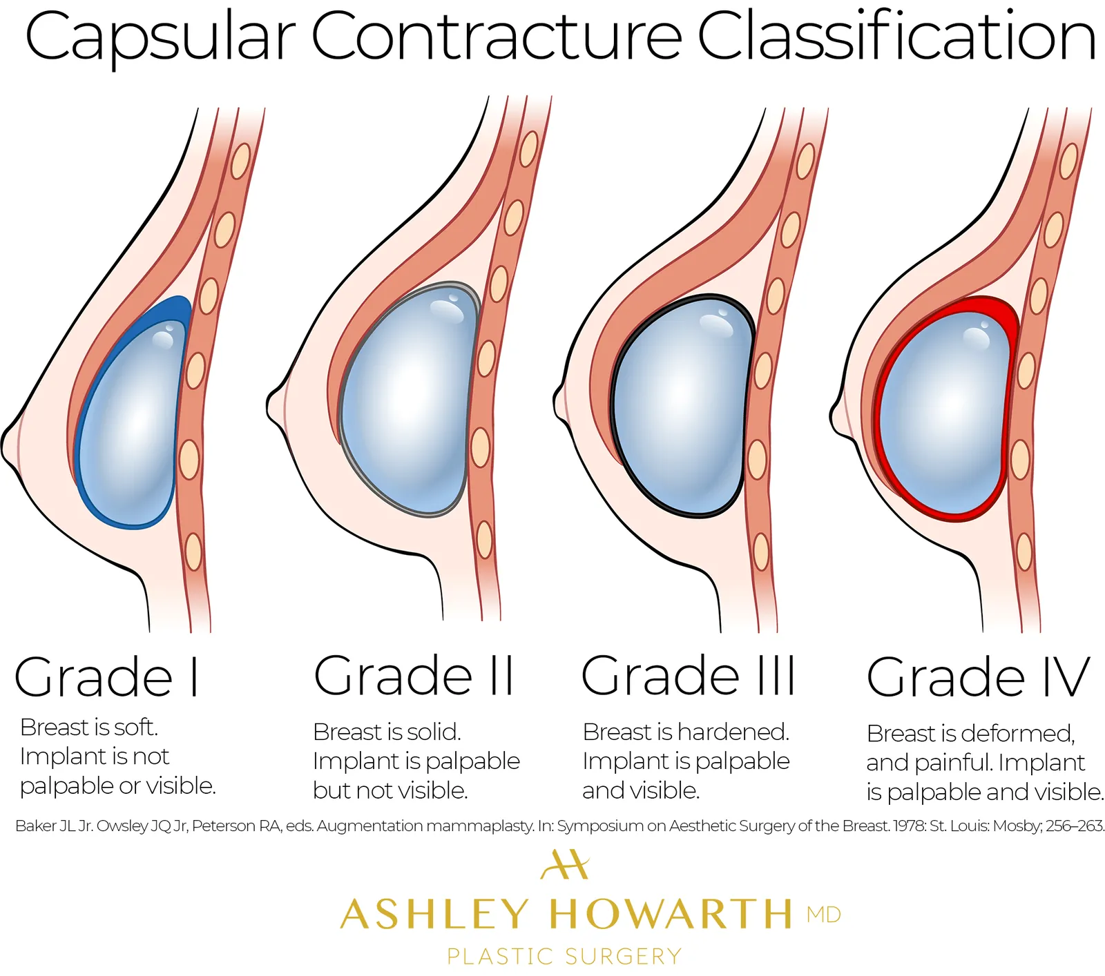 Baker Grades Capsular Contracture