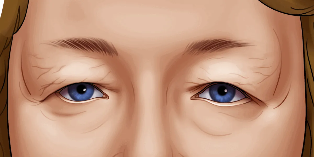 How to qualify for eyelid surgery? How much is blepharoplasty? Eyelid surgery cost