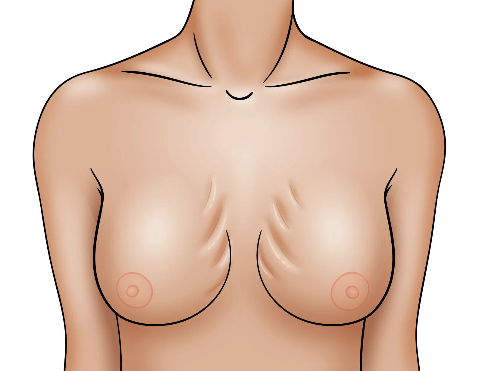 Breast implant rippling