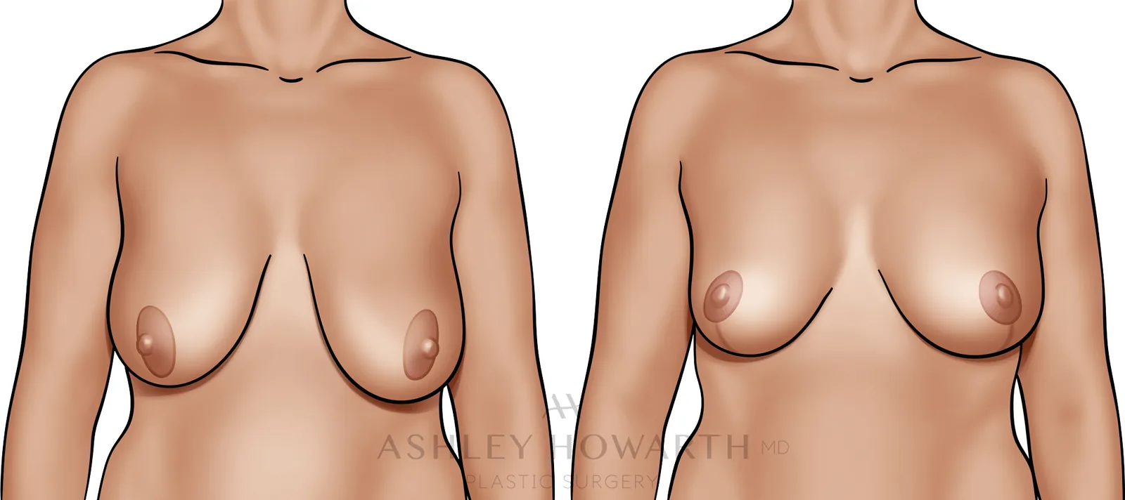 Breast Lift Without Implants