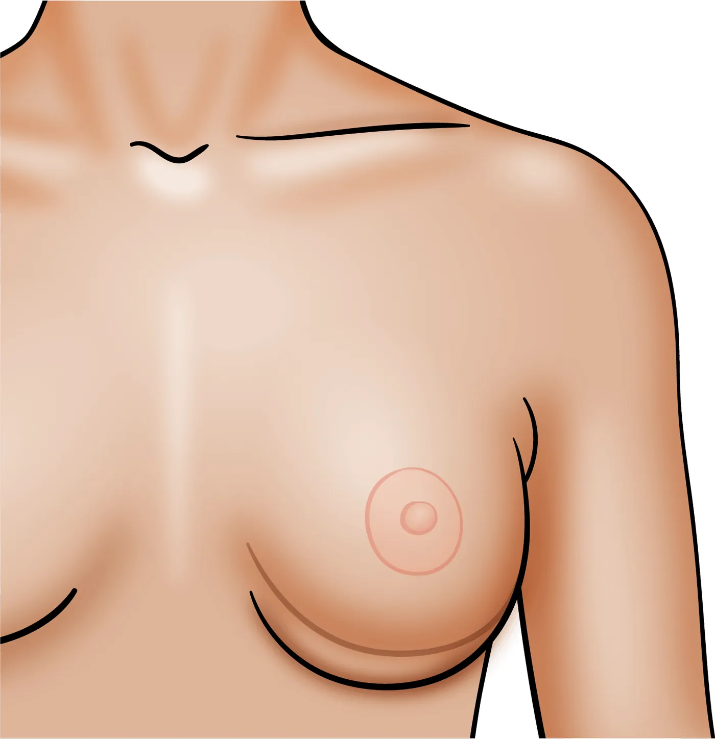 Double Bubble Breast Implant Deformity