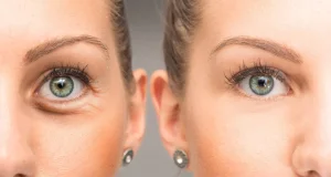 Eyelid Surgery Before After