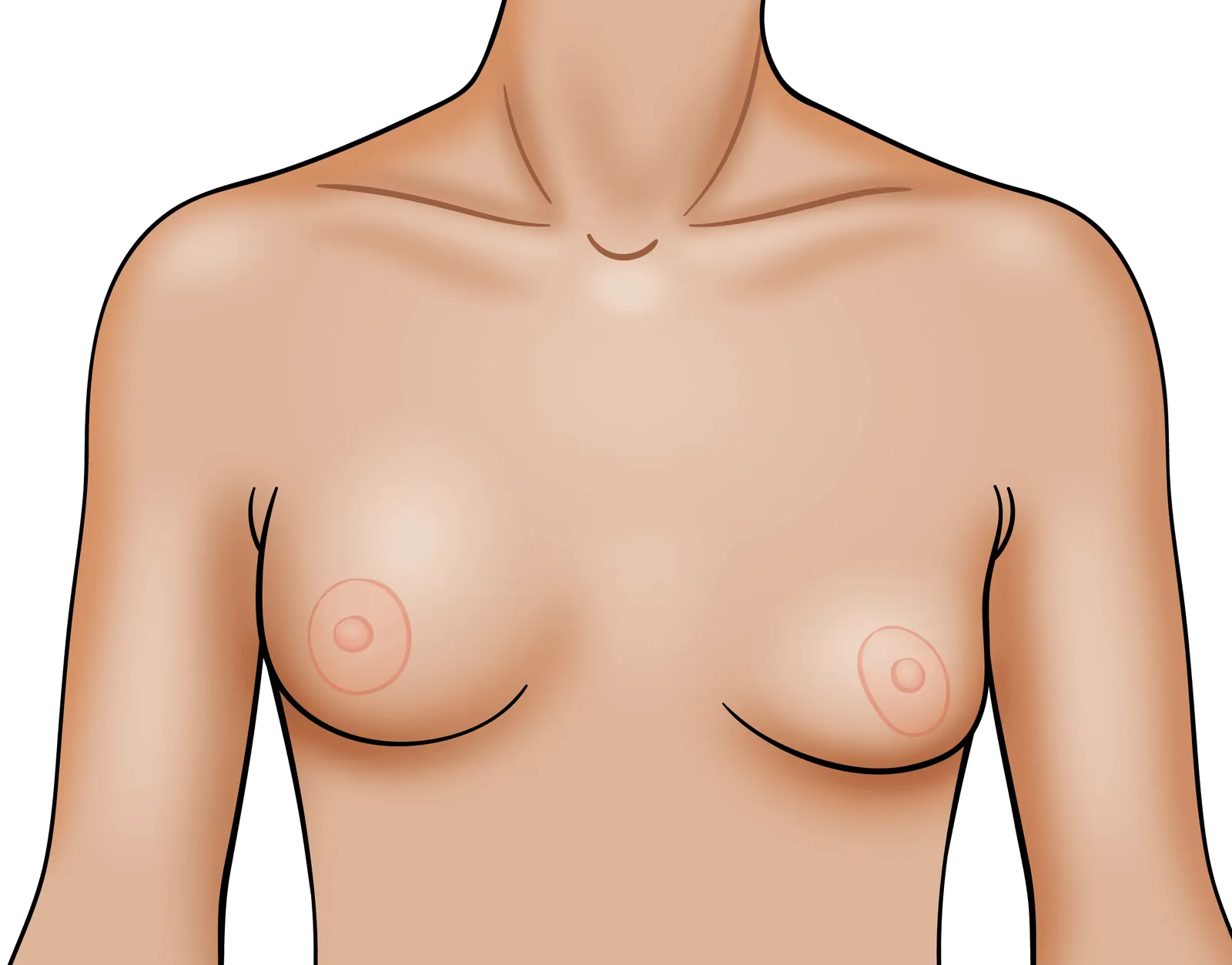 Saline Breast Implant Rupture Scottsdale Phoenix AZ