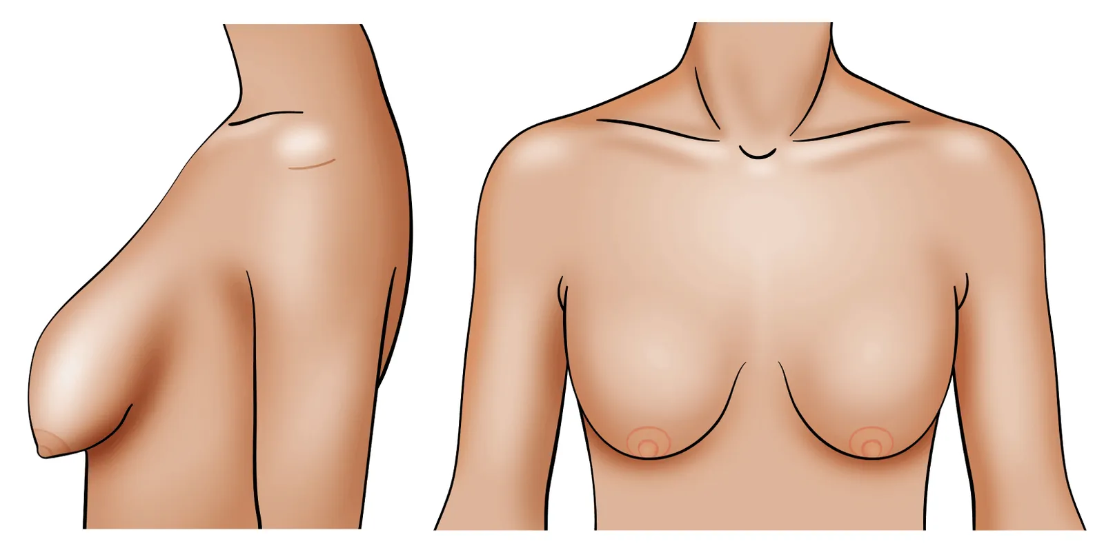 Fix Sagging Breasts Scottsdale - Sagging Breasts AZ