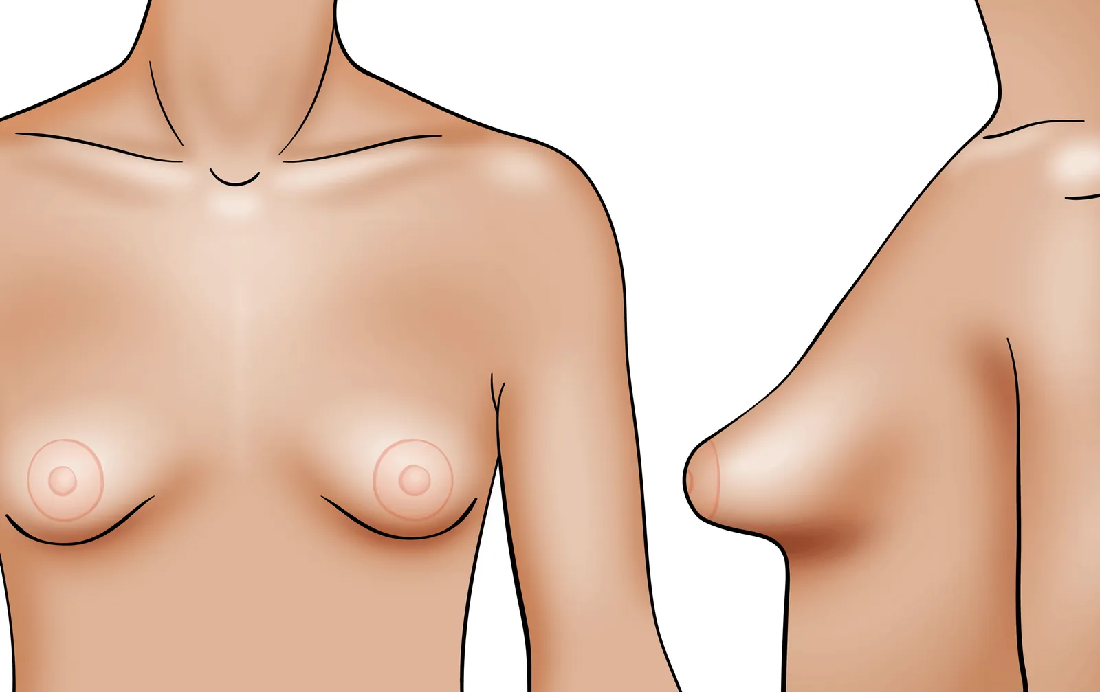 Tubular breasts or tuberous breasts